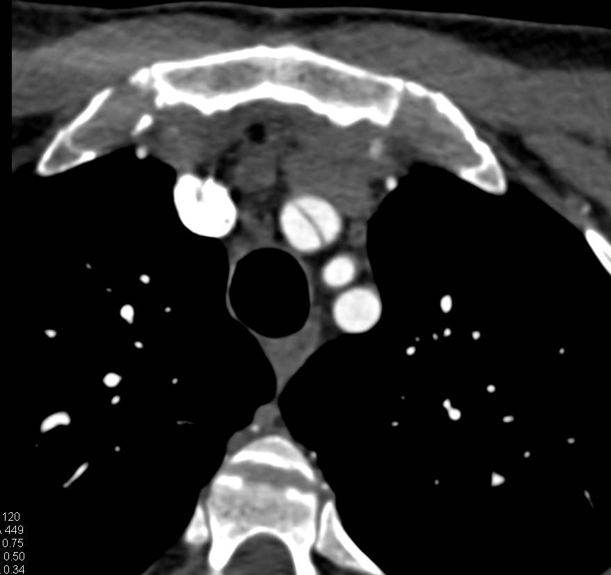 Aortic Dissection Involved the Right Innominate Artery - CTisus CT Scan