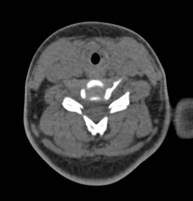 Asymmetric Airway Thickening due to Prior Intubation - CTisus CT Scan