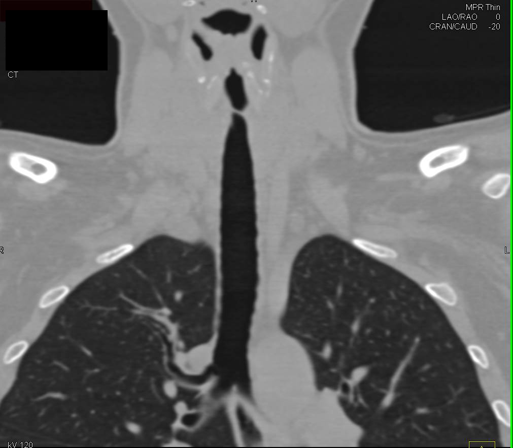 Airway Stenosis in 3D - CTisus CT Scan