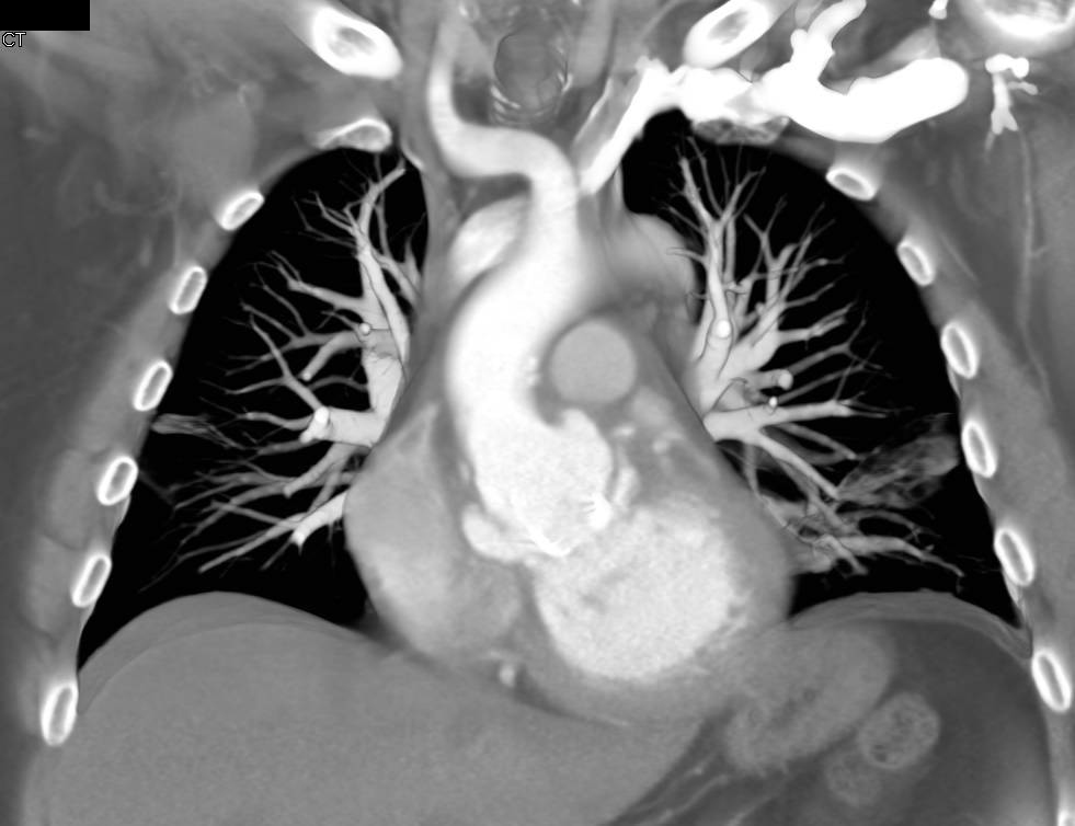 Pseudoaneurysms off the Aortic Root - CTisus CT Scan