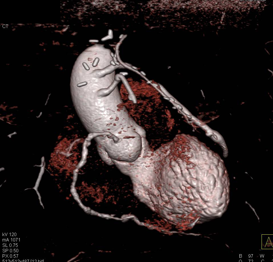 CCTA: Coronary Artery Bypass Graft (CABG) with one of the Venous Grafts Occluded - CTisus CT Scan