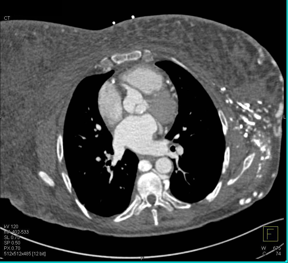 Extensive Vascular Collaterals Left Axilla and Intercostals due to Subclavian Vein Occlusion (Left) - CTisus CT Scan