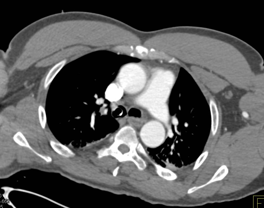 Endotracheal Tube Extends into the Right Mainstem Bronchus - CTisus CT Scan