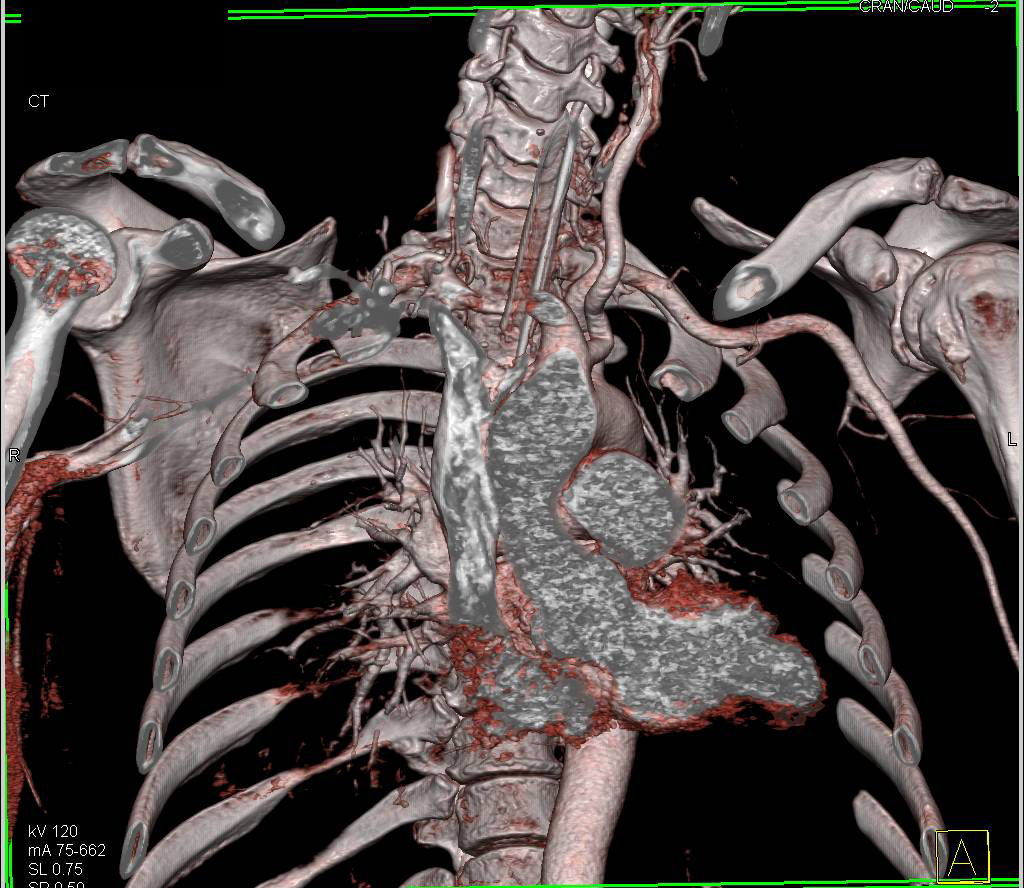 Misplace Endotracheal Tube into Right Mainstem Bronchus - CTisus CT Scan