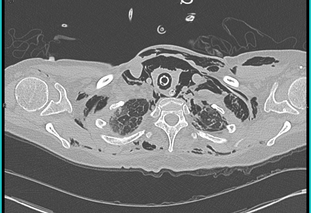 Pneumomediastinum and Extensive Subcutaneous Air in Acute Respiratory Distress Syndrome (ARDS) - CTisus CT Scan