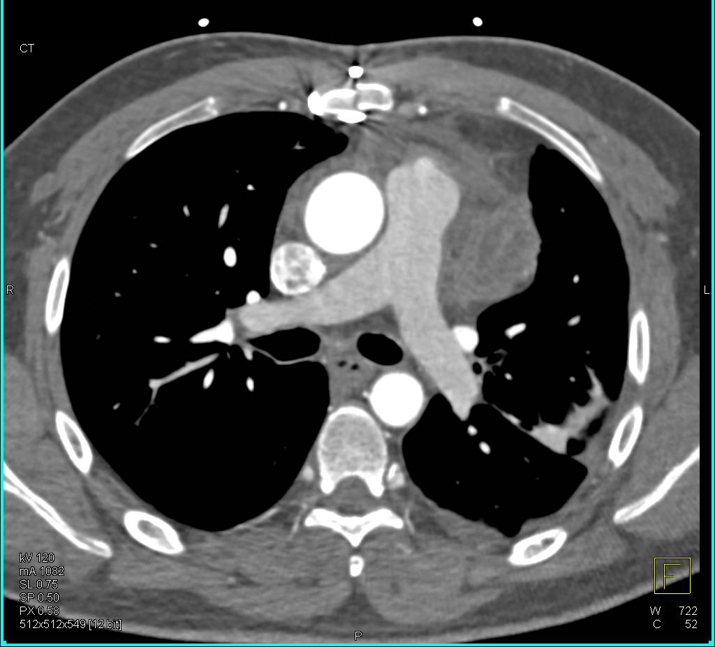 Bovine Arch - CTisus CT Scan