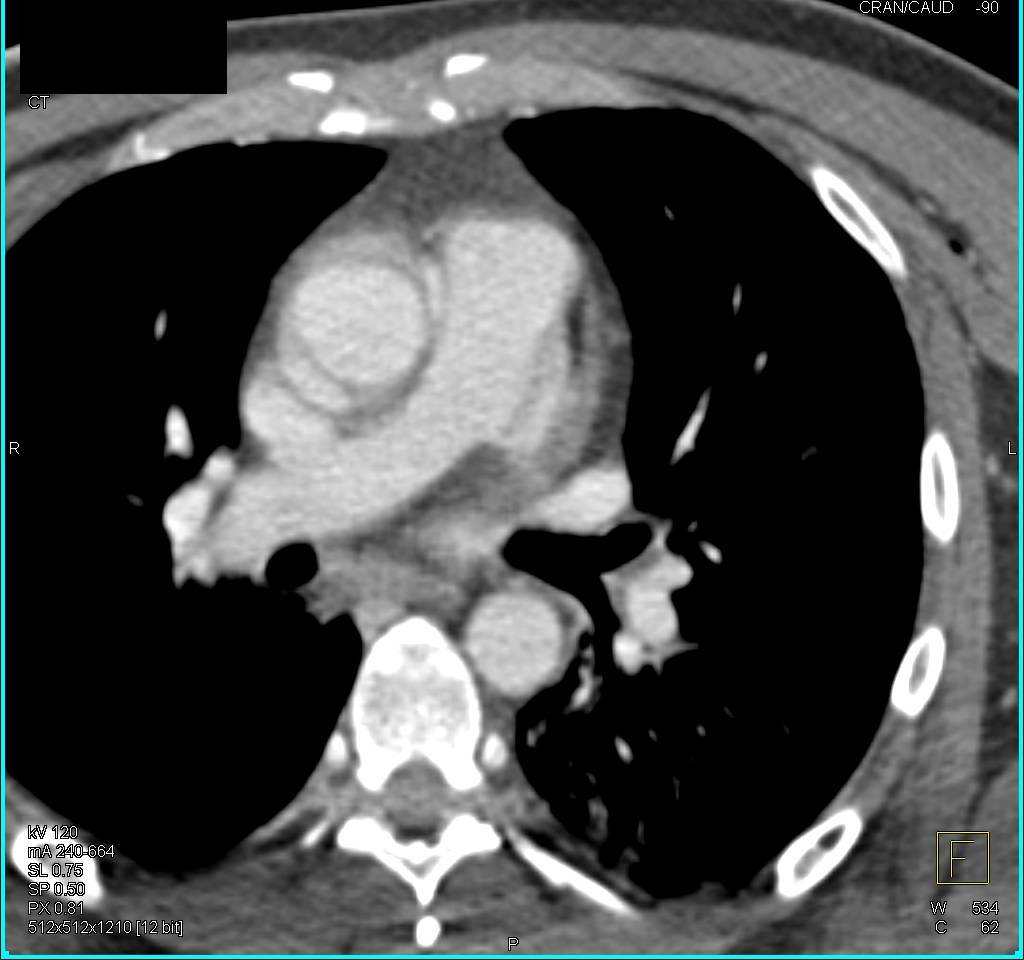 Pseudodissection Ascending Aorta on Nongated Images in Trauma Patient - CTisus CT Scan