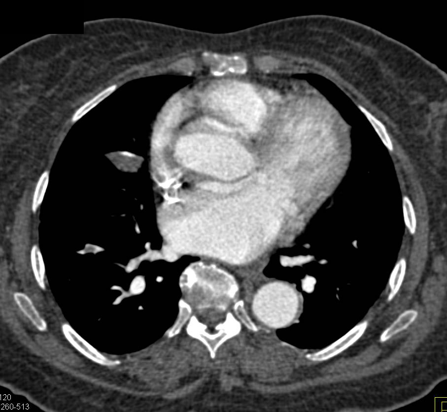 Pulmonary Embolism in Patient with Pelvic Sarcoma - CTisus CT Scan