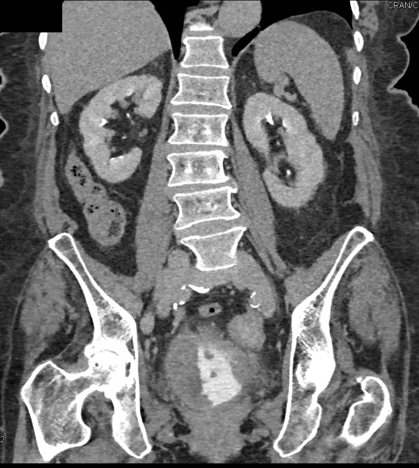 Incidental Pulmonary Embolism (PE) in Patient seen in Multiple Perspectives - CTisus CT Scan