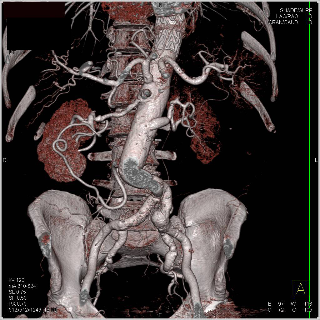 Endovascular Stent in Descending Thoracic Aorta as well as Superior ...