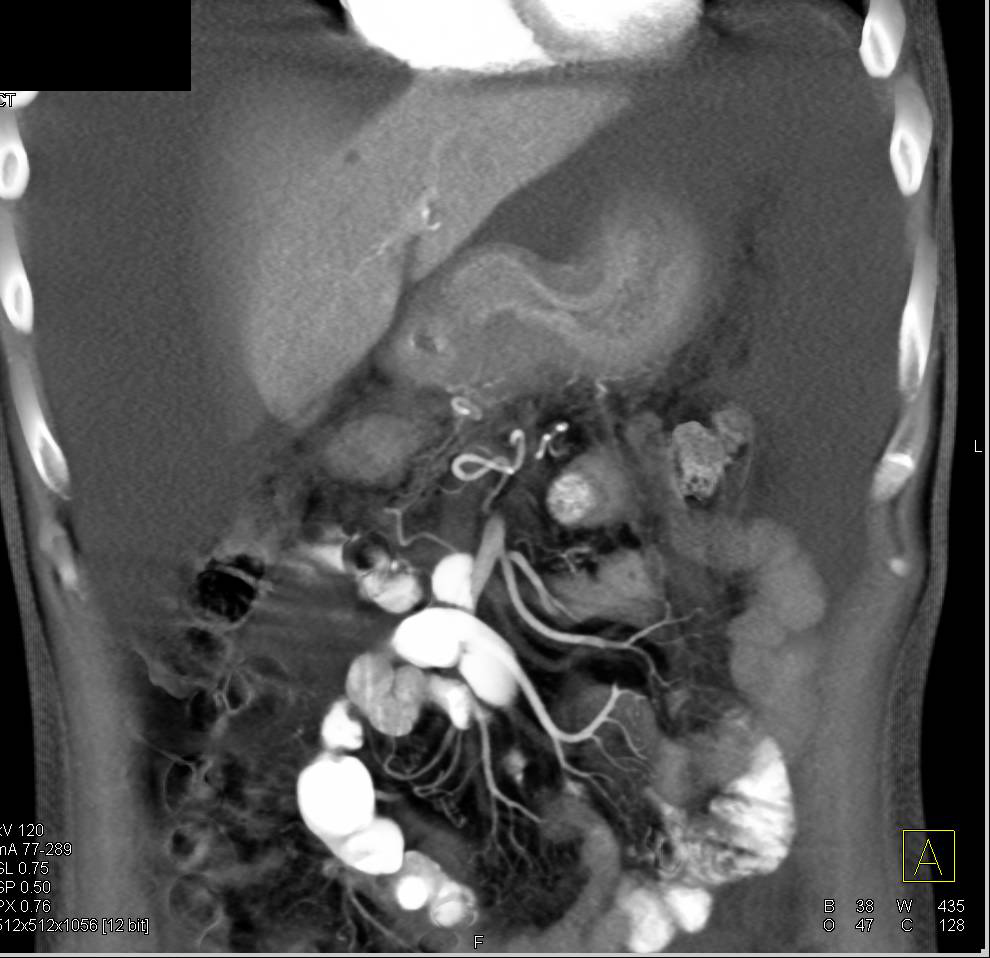 Linitis Plastica Stomach with Ascites Secondary to Breast Cancer Metastases - CTisus CT Scan