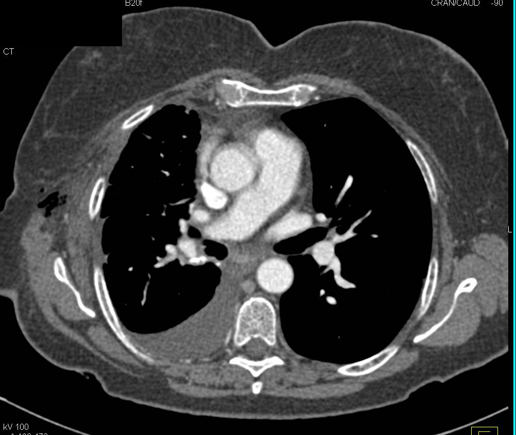 Resection of Accessory Bronchus in Right Upper Bronchus - CTisus CT Scan