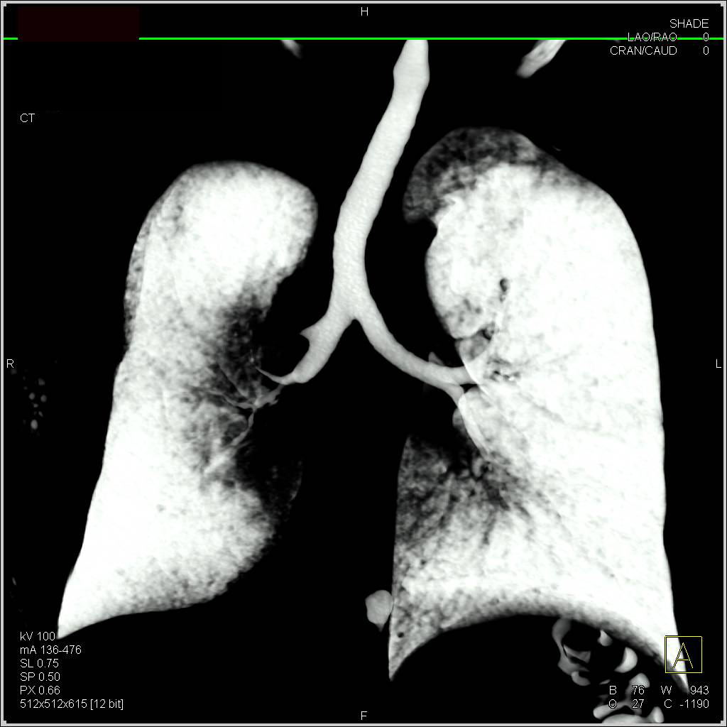 Virtual Bronchoscopy with Resection of Accessory Bronchus in Right Upper Bronchus - CTisus CT Scan