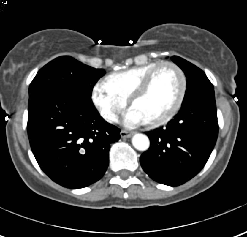 Pulmonary Embolism Right Lower Lobe - CTisus CT Scan