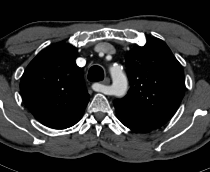 Aberrant Origin of Right Subclavian Artery in a Patient with Intraductal Papillary Mucinous Neoplasm (IPMN) in Head of Pancreas - CTisus CT Scan