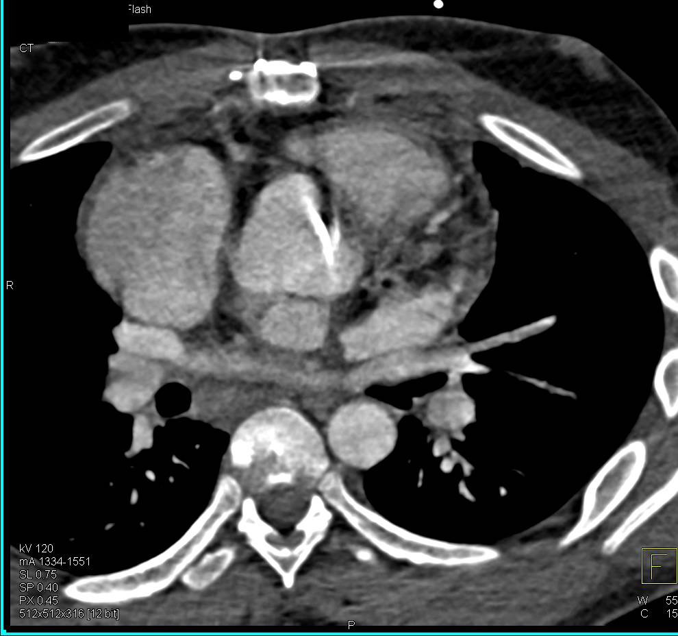 Cardiomegaly with Aortic Valve Replacement (AVR) - CTisus CT Scan