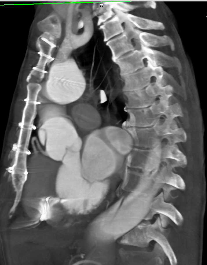 Type A Dissection Nicely Seen with Gated Acquisition - CTisus CT Scan