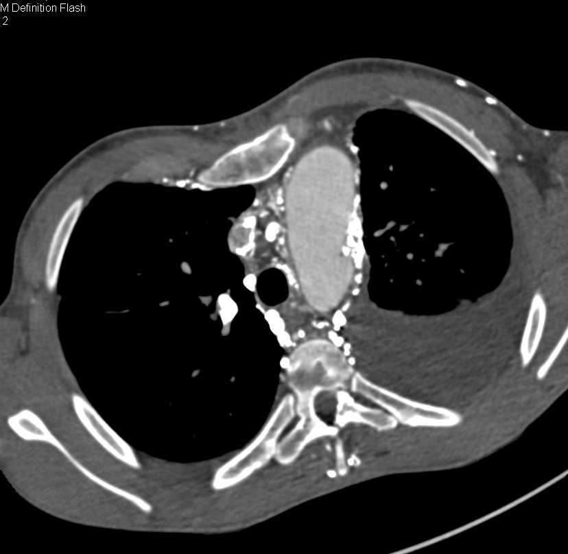 Superior Vena Cava (SVC) Occlusion with Extensive Collaterals - CTisus CT Scan