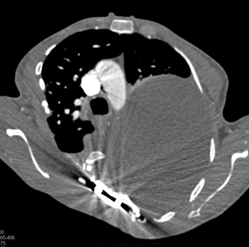 Neurogenic Tumor - CTisus CT Scan