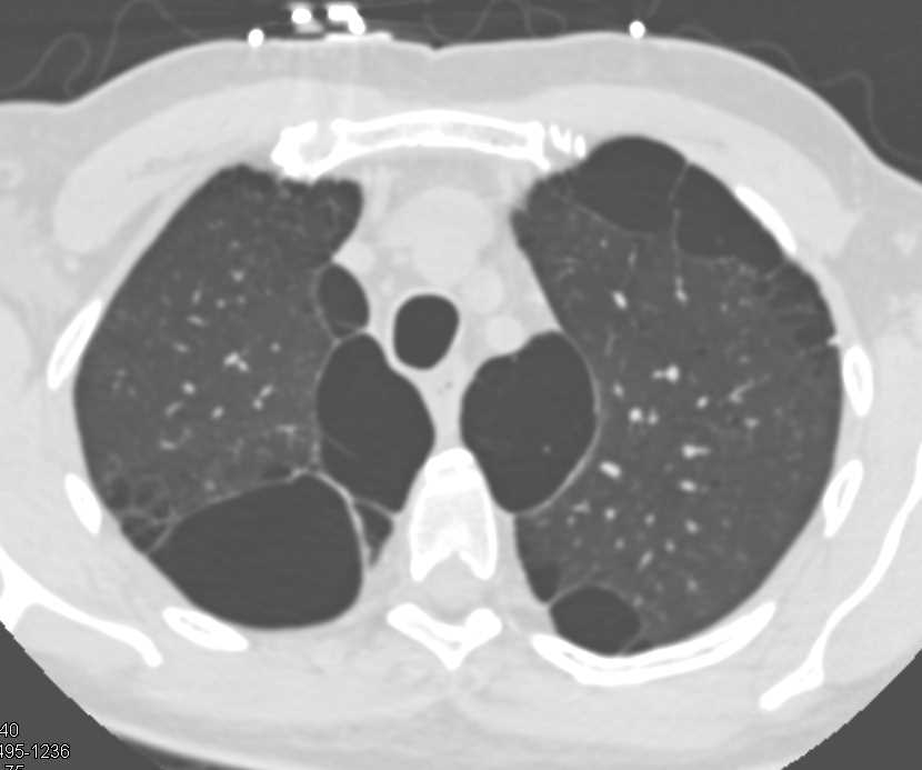 Emphysema with Bullous Disease - CTisus CT Scan