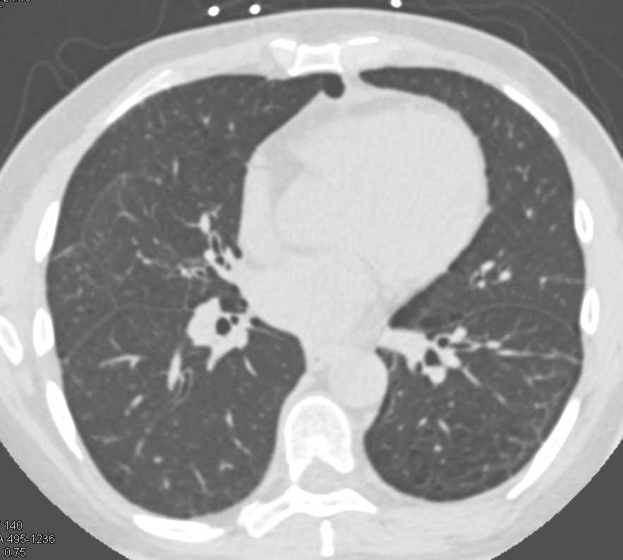 physiologic dead space in emphysema