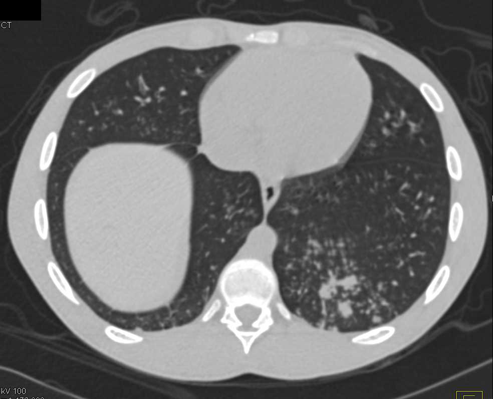 Air Space Filling Left Lower Lobe due to Mycobacterium avium/intracellulare (MAI) Infection - CTisus CT Scan