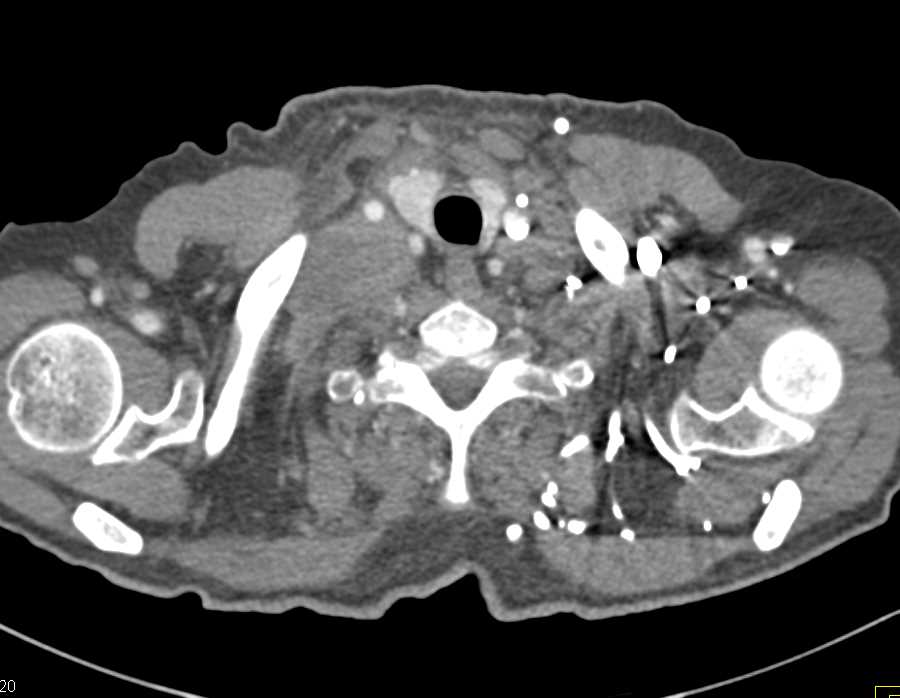 Lymphoma with Extensive Adenopathy and Encasement of the Pulmonary Artery - CTisus CT Scan