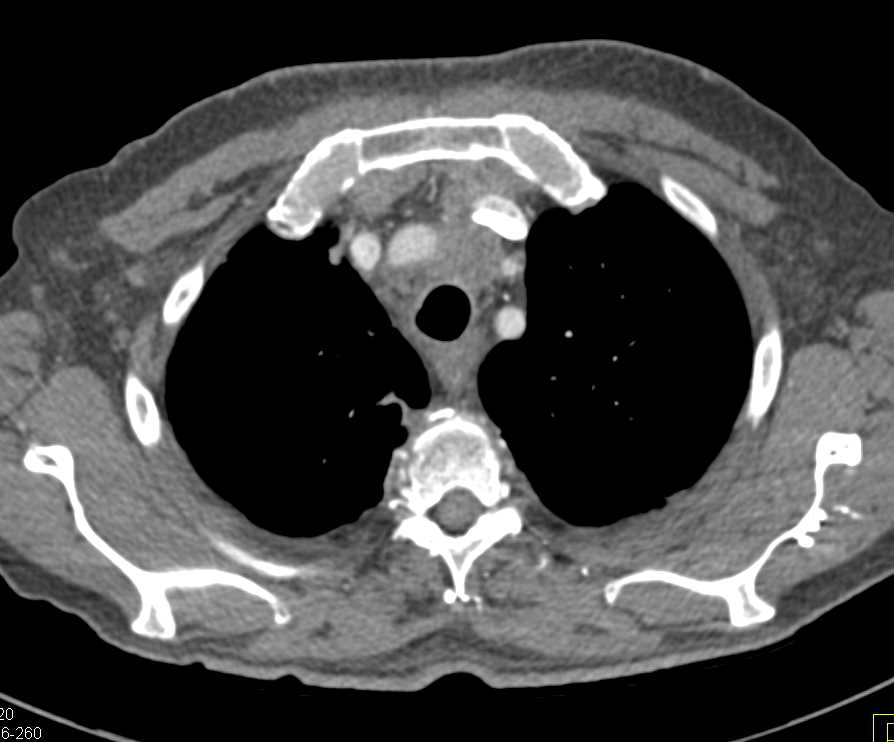 Lymphoma with Extensive Adenopathy and Encasement of the Pulmonary Artery - CTisus CT Scan