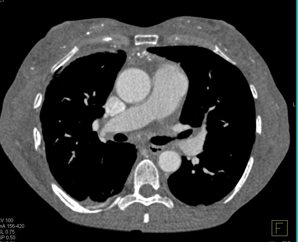 Extensive Calcifications in the Soft Tissue due to Long Standing Renal Failure - CTisus CT Scan