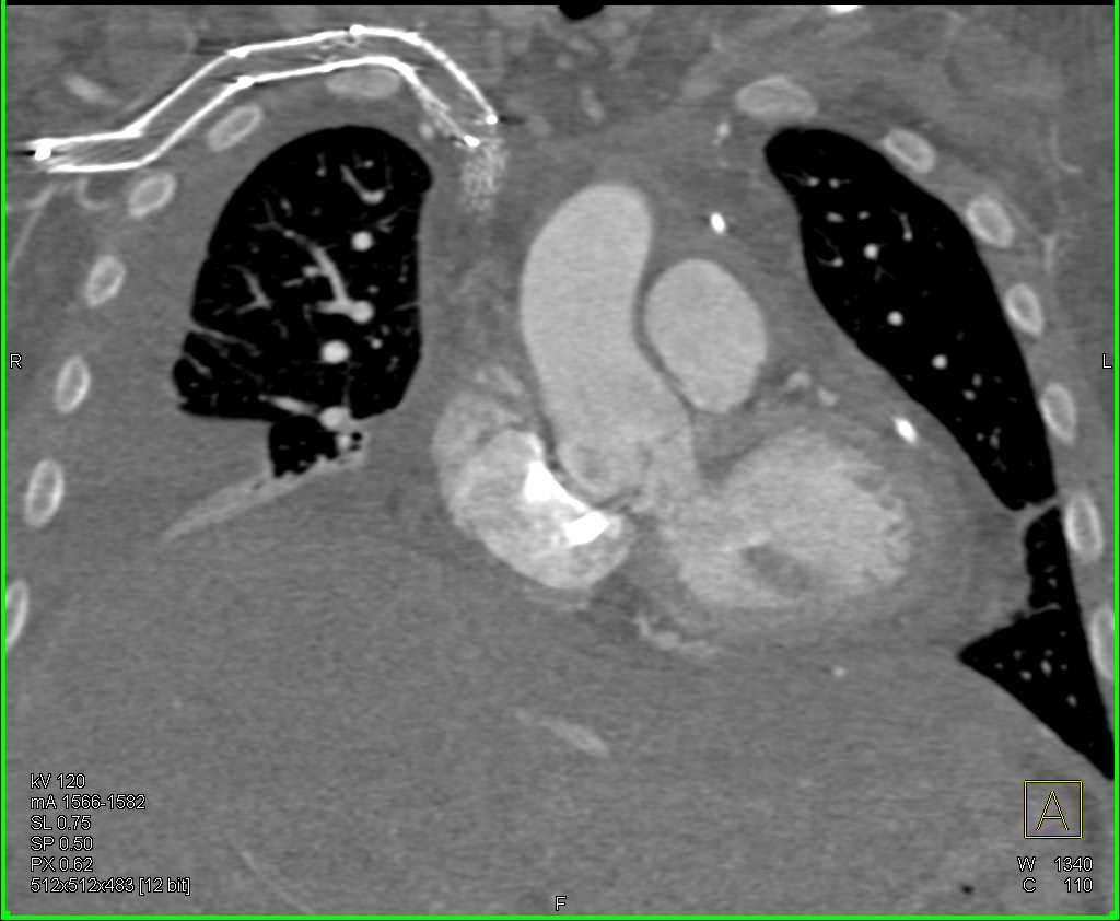 Stent from Axillary Vein to Superior Vena Cava (SVC) is Occluded - CTisus CT Scan