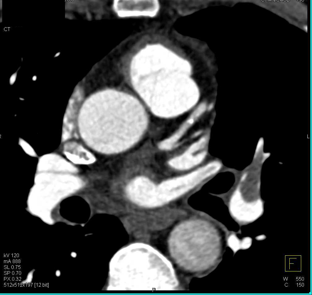 Extensive Pulmonary Embolism on a Triple Rule Out Study - CTisus CT Scan