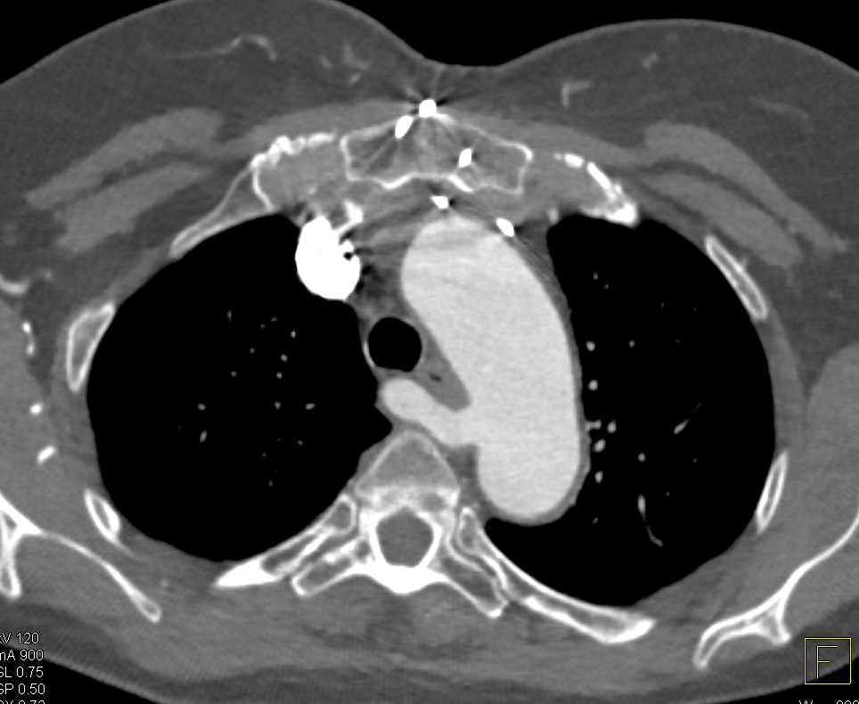 Aberrant Origin of Right Subclavian Artery - CTisus CT Scan