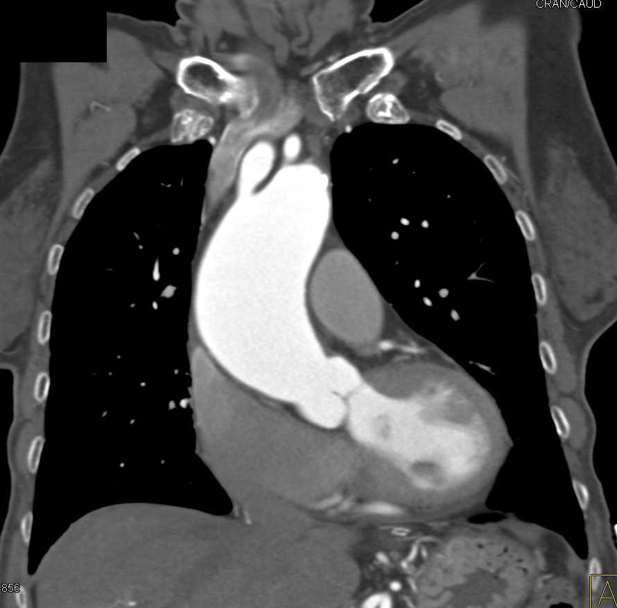 Aortic Valve Stenosis and Dilated Ascending Aorta with Bovine Arch ...