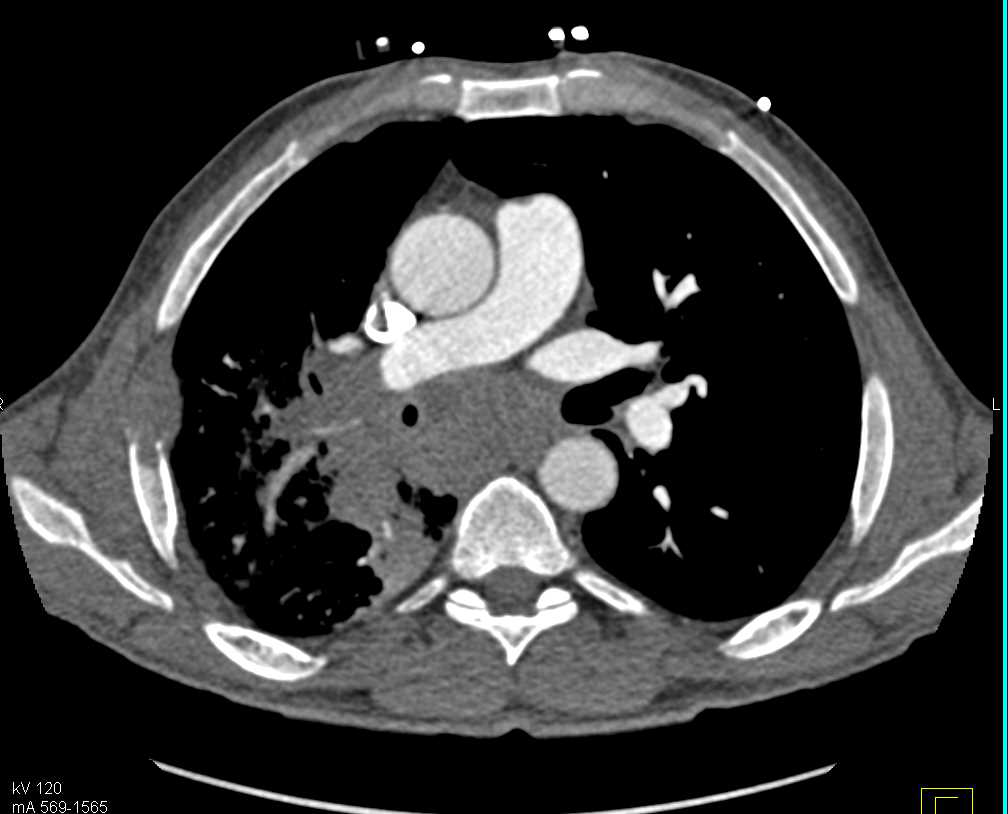 Non-Small Cell Lung Cancer (NSCLC) with Vessel Encasement and Rib Metastases - CTisus CT Scan