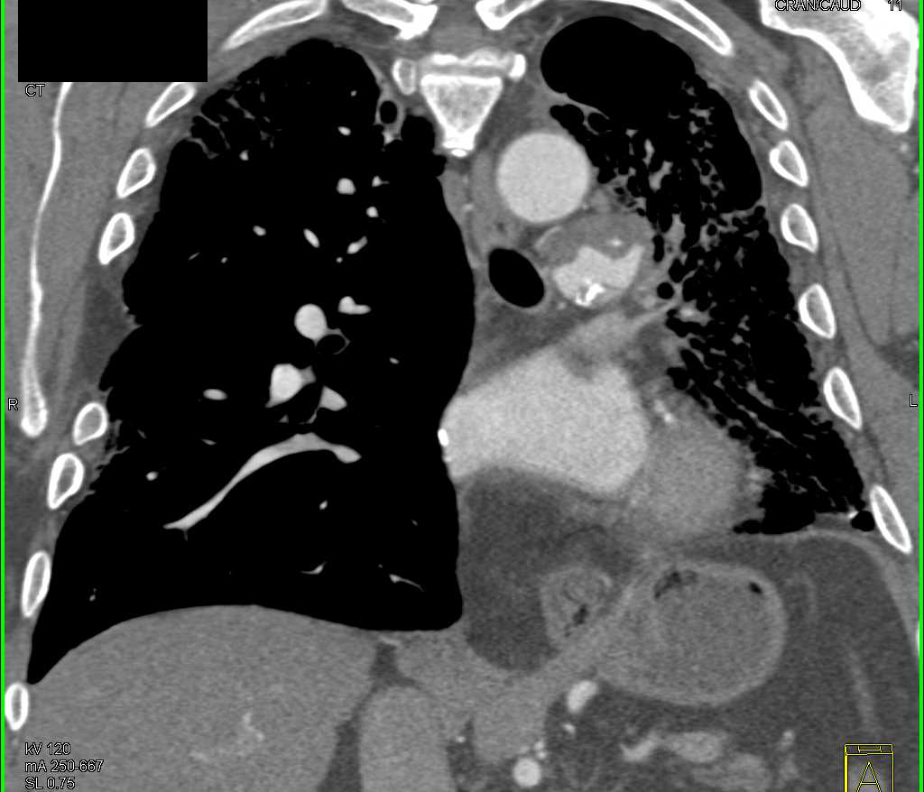 Pulmonary Embolism and Fibrosis in Right Lung - CTisus CT Scan
