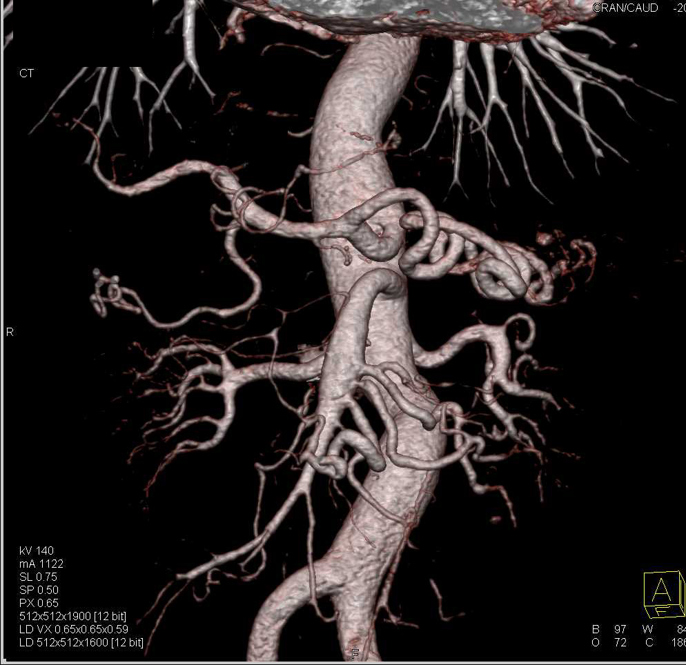 Loeys-Dietz Syndrome with Aneurysms of the Left Subclavian, Left Vertebral and Superior Mesenteric Artery (SMA) Arteries - CTisus CT Scan