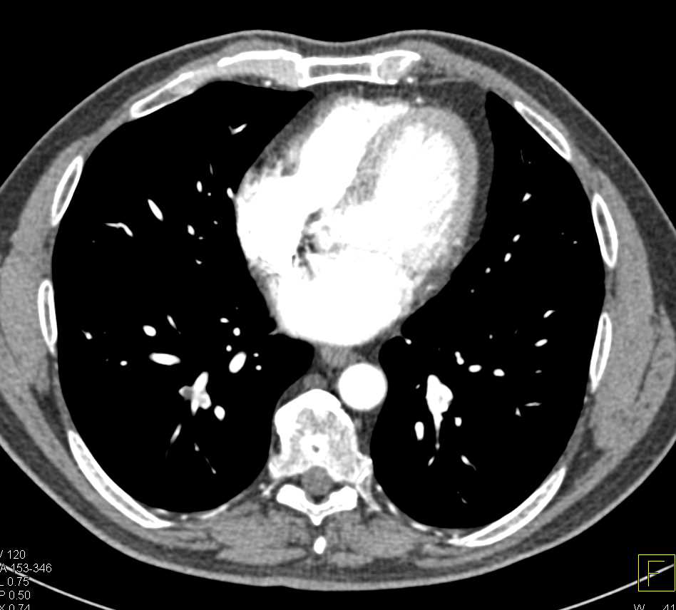 Incidental PE - CTisus CT Scan