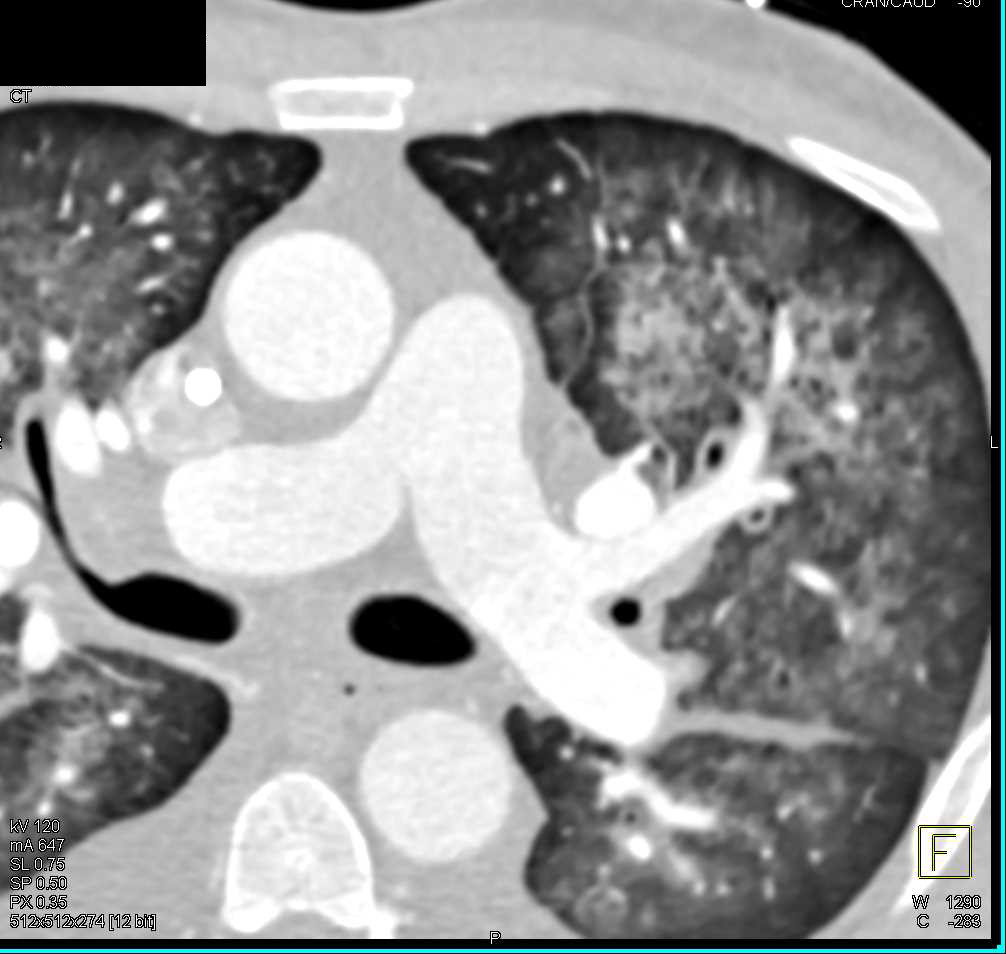 Pulmonary Hemorrhage - CTisus CT Scan