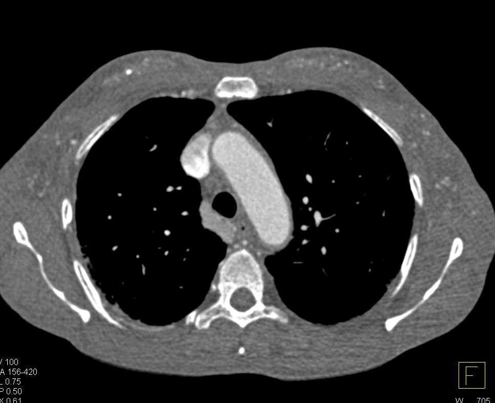 Faint Calcification in the Chest Wall - CTisus CT Scan