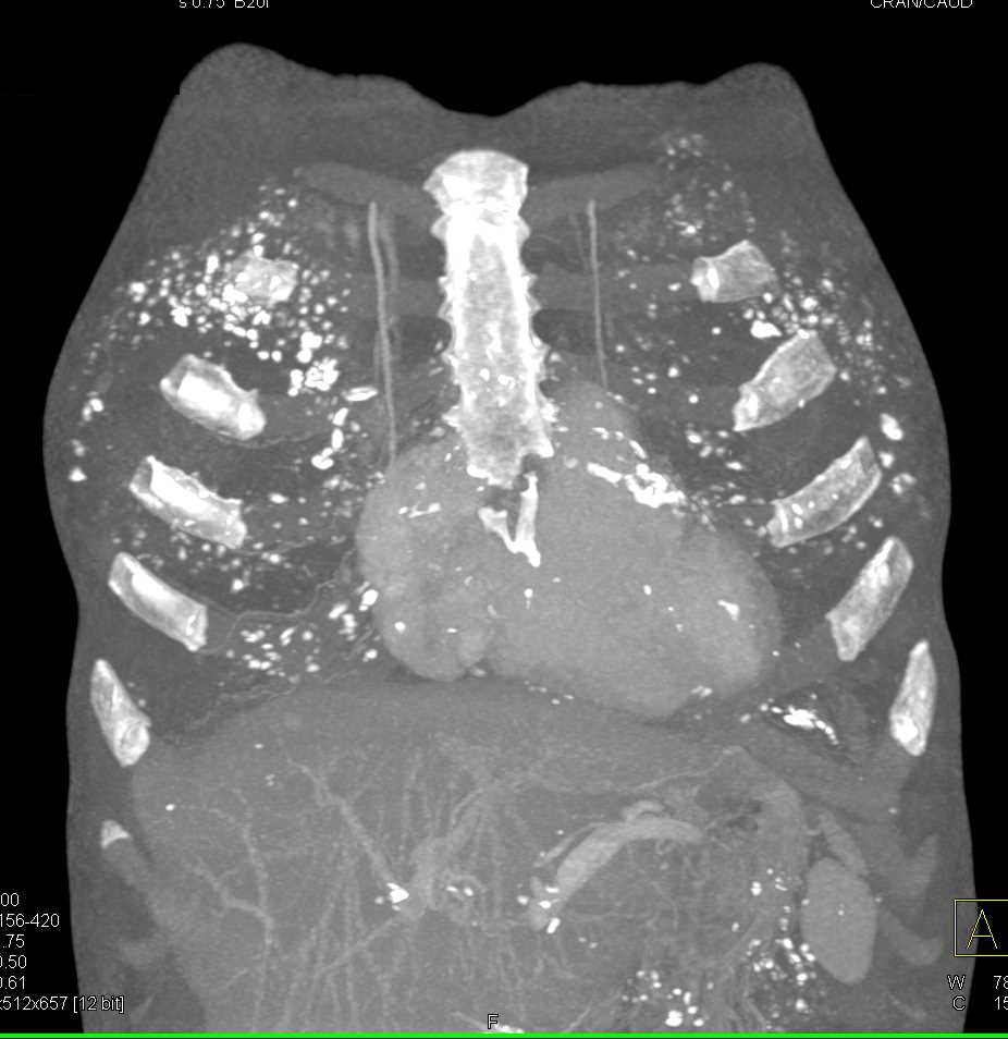 Faint Calcification in the Chest Wall - CTisus CT Scan