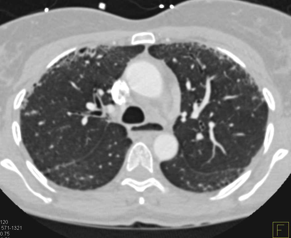 Mild Interstitial Disease Seen on MIP Imaging - CTisus CT Scan