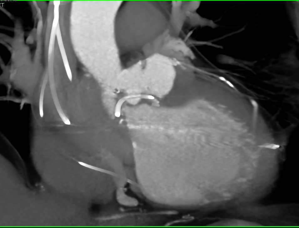 Saccular Dilatation of Sinus of Valsalva Post Aortic Valve Replacement (AVR) - CTisus CT Scan