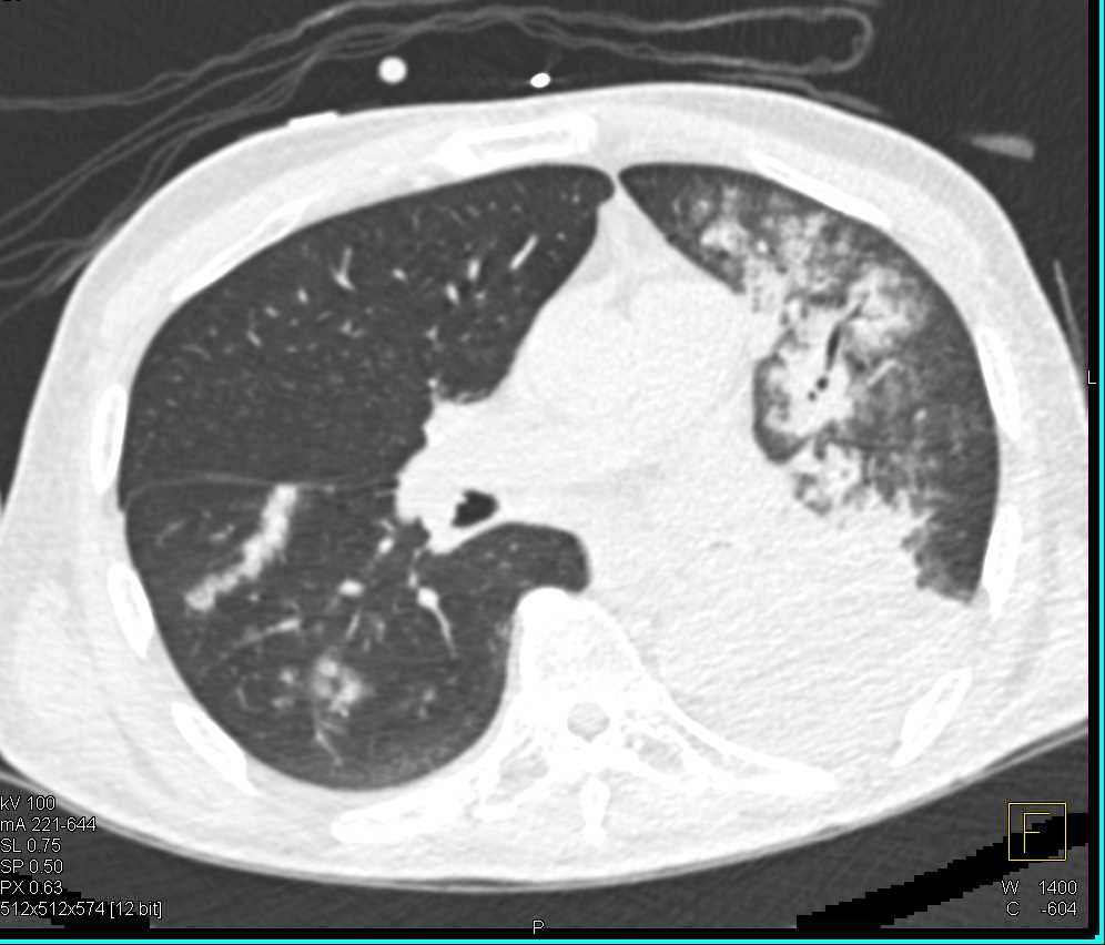 Bronchoalveolar Cell Carcinoma - CTisus CT Scan