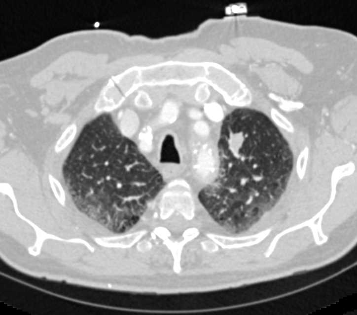 Incidental Scar Carcinoma Left Upper Lung - CTisus CT Scan