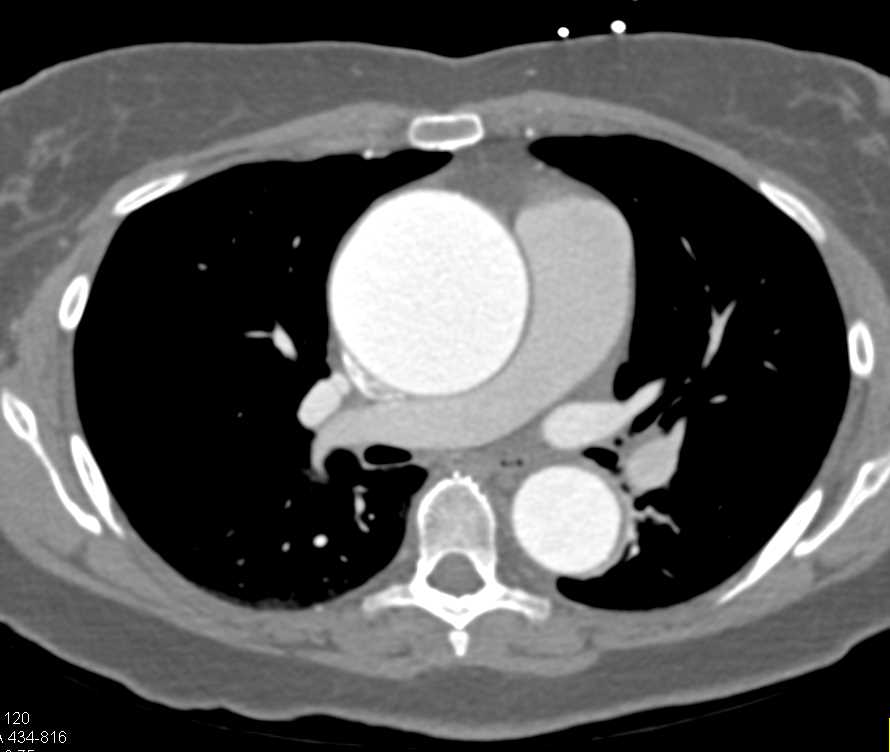 Dilated Ascending Aorta from the Valve and Up - CTisus CT Scan