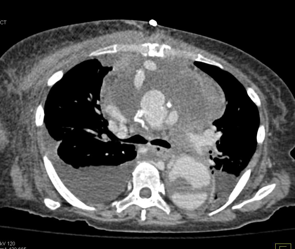 Pseudoaneurysm of the Aortic Root - CTisus CT Scan