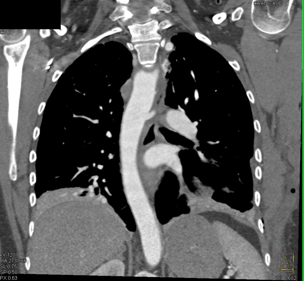 Reimplantation of Left Subclavian Artery - CTisus CT Scan