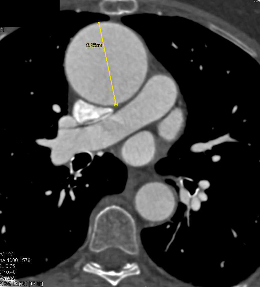 Dilated Ascending Aorta and Aberrant Right Subclavian Artery - CTisus CT Scan