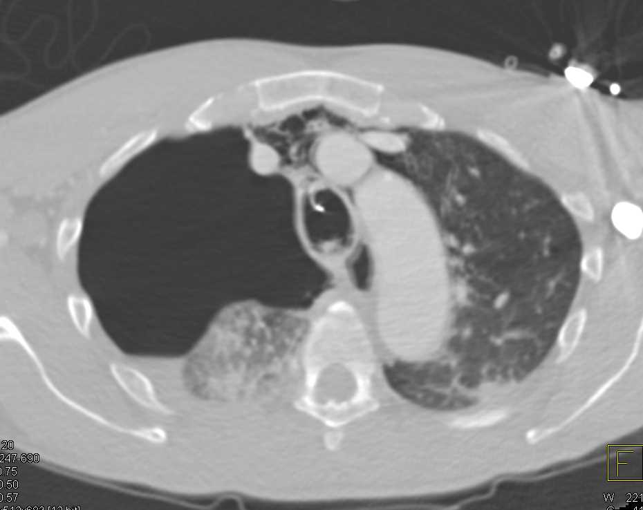 Pneumothorax and Pneumomediastinum - CTisus CT Scan