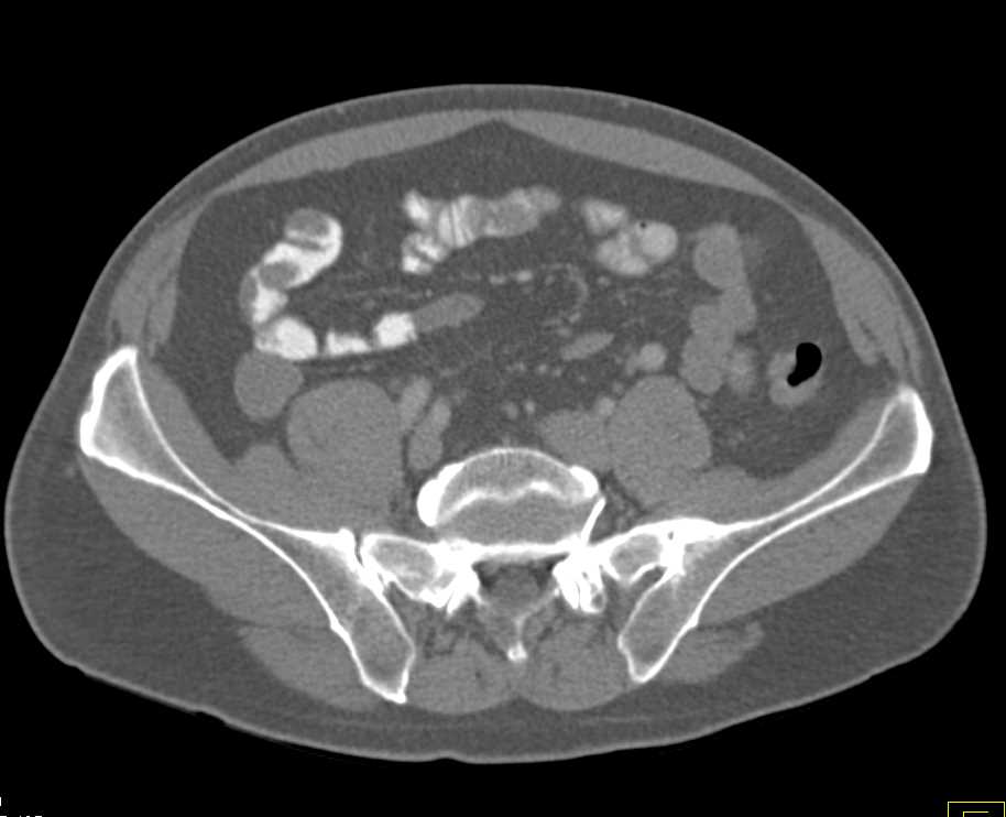 Lymphoma Involving Hilar Nodes and the Small Bowel - CTisus CT Scan